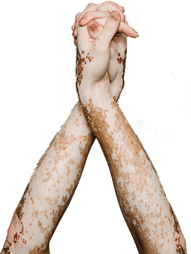 vitiligo 2 min